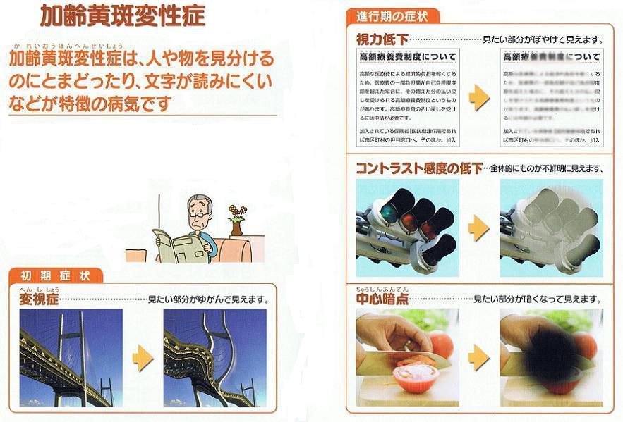 “耳より情報”①加齢黄班変性症